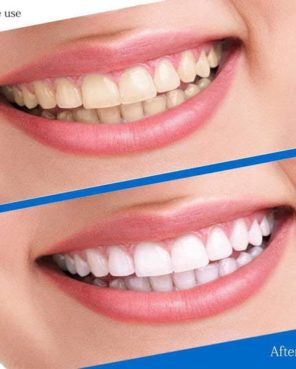 Dantų balinimo juostelės 5D Whitening 14vnt/7 poros